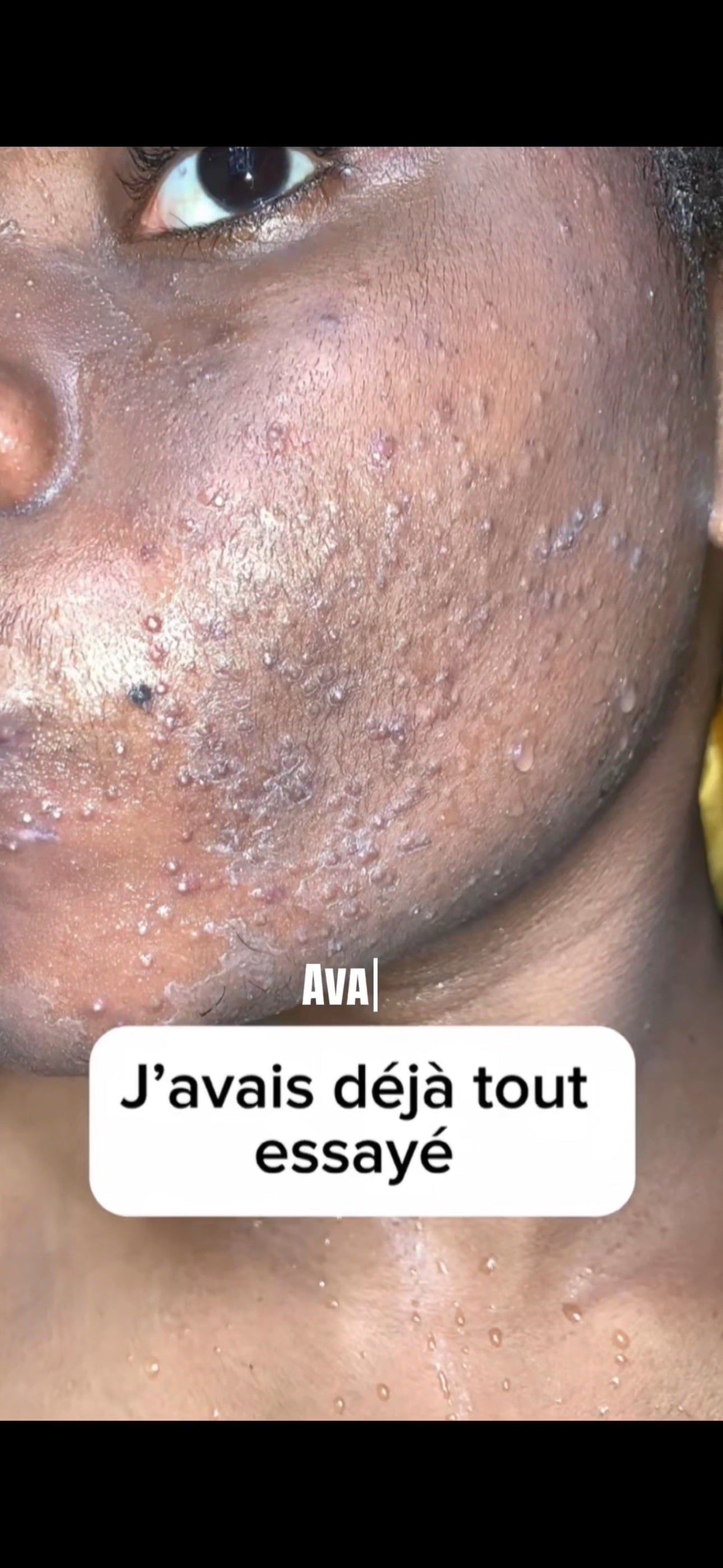 Avant : peau avec taches et imperfections