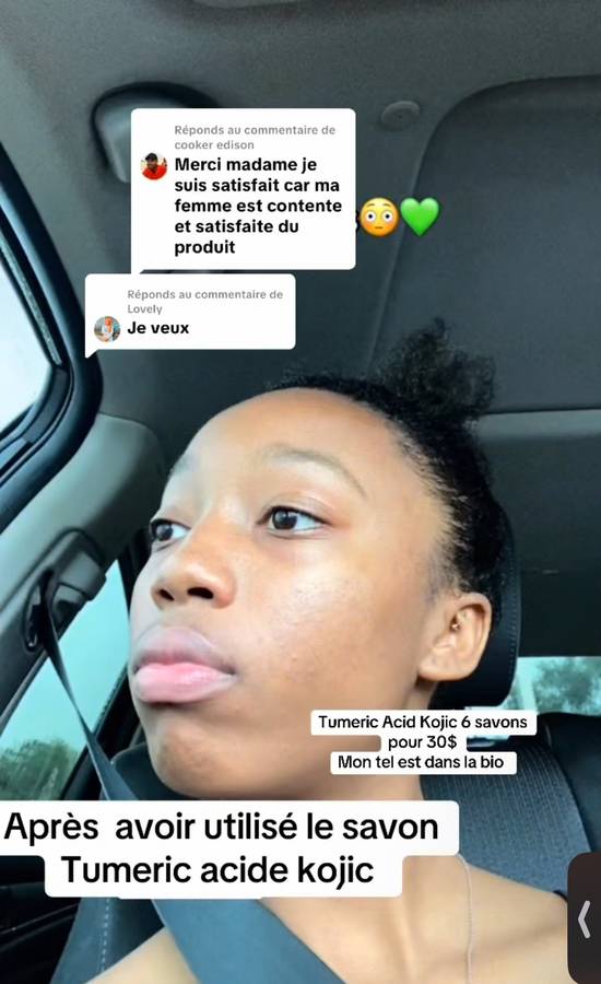 Après — Boutons d'acné, visage