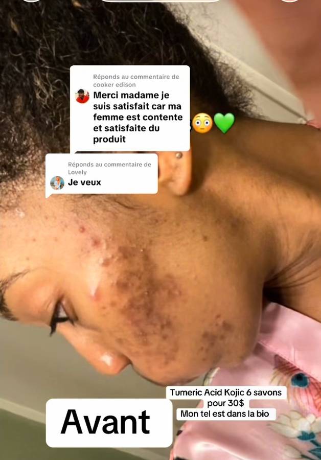 Avant — Boutons d'acné, visage