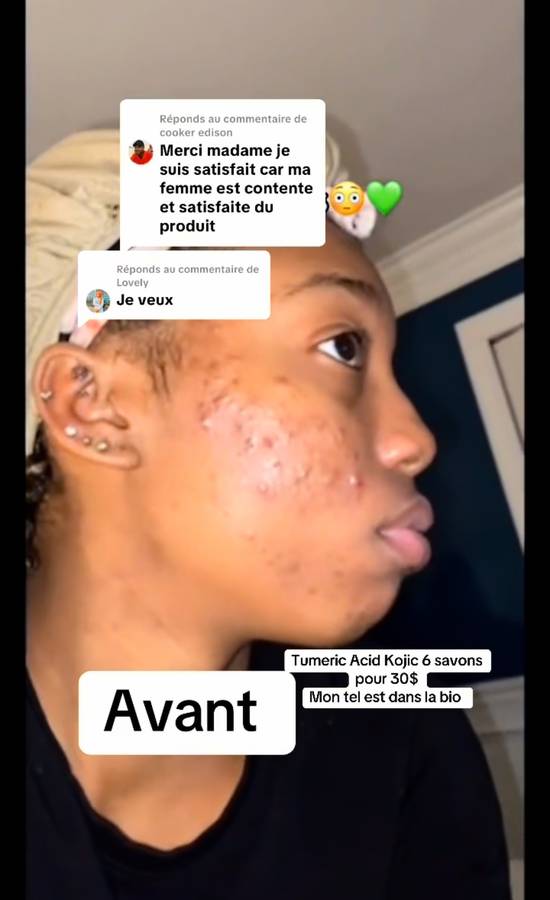 Avant — Boutons d'acné, profil